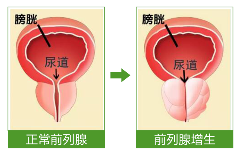 泌尿系结石包括哪些？听听医生怎么说