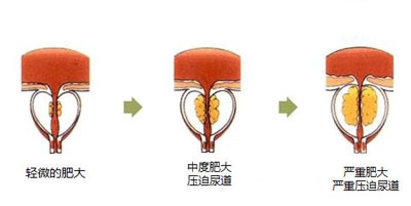 泌尿系结石有哪些？从肾到膀胱，你了解多少？
