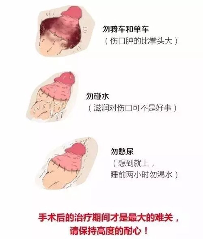 泌尿系结石是什么原因引起的？让我们一起揭开它的面纱。